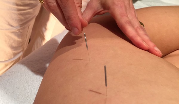 Acupuncture