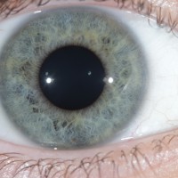 Iridology/Iris diagnosis