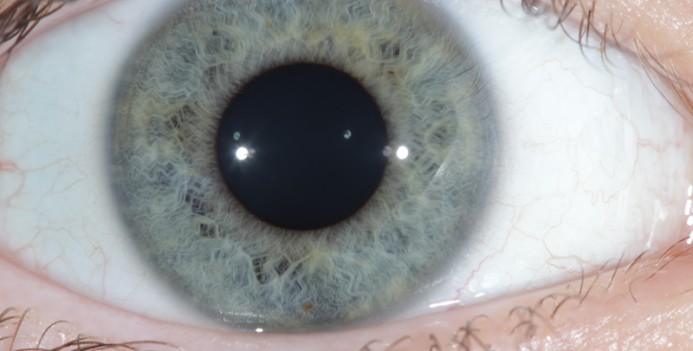 Iridology/Iris diagnosis